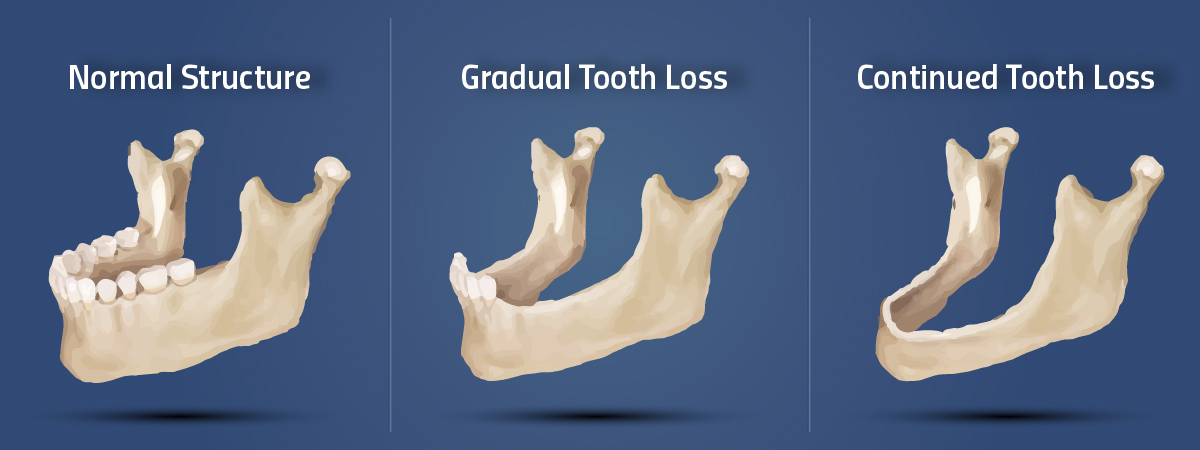 Jaw tooth loss