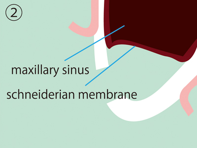 Sinus lift procedure 2