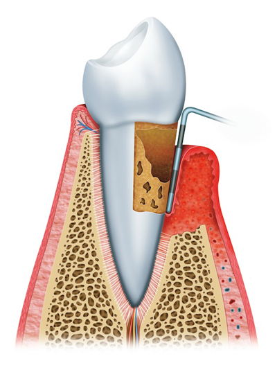 Stages of Gum Disease Worthington and Columbus, OH