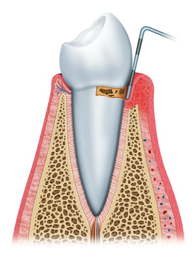 Stages of Gum Disease Worthington and Columbus, OH