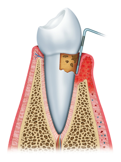 Stages of Gum Disease Worthington and Columbus, OH