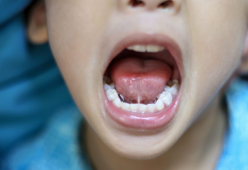 Lingual Frenectomy