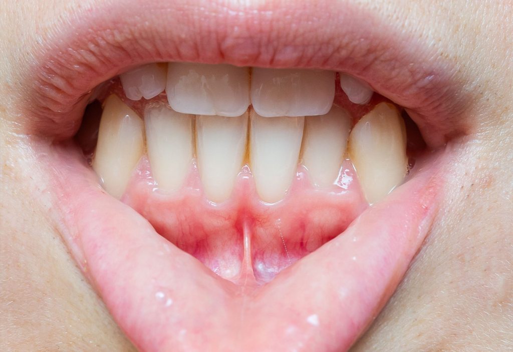 Labial Frenectomy