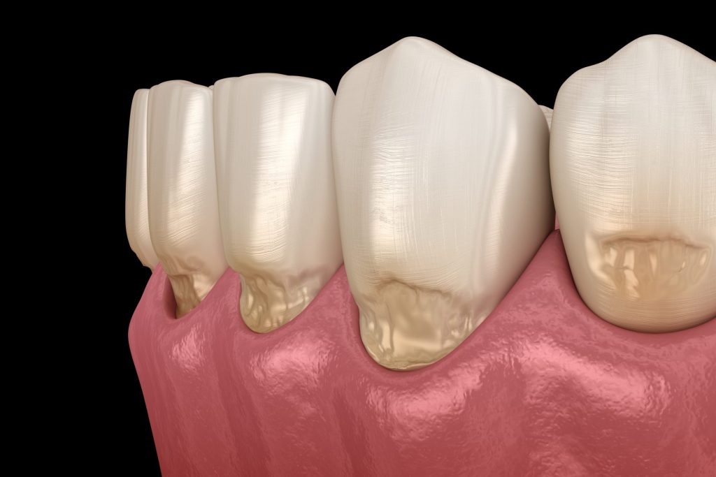Gingival Recession and the Crown
