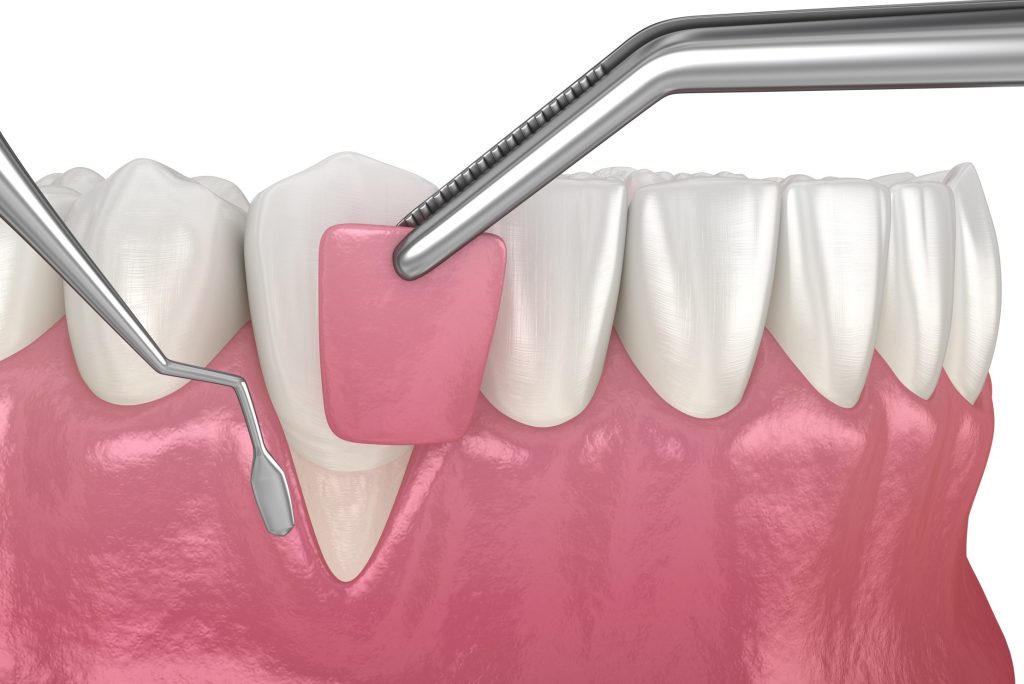 Connective Tissue Graft