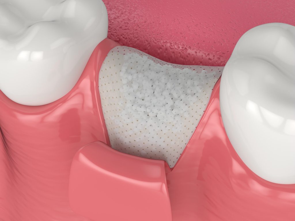 Preventing Unwanted Tissue Growth