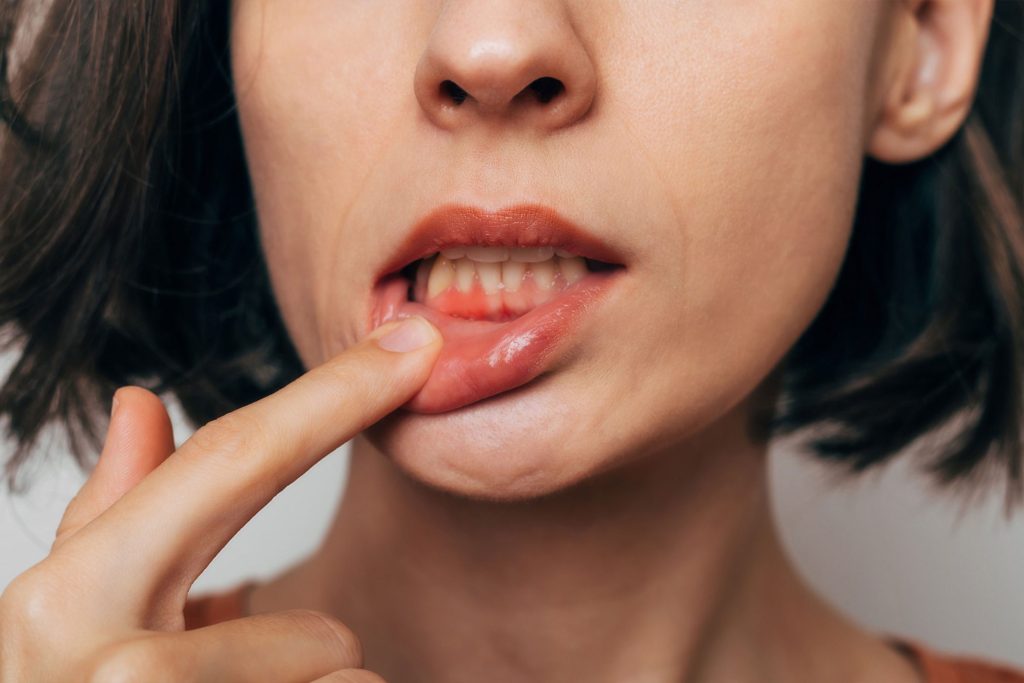 Gum Infection