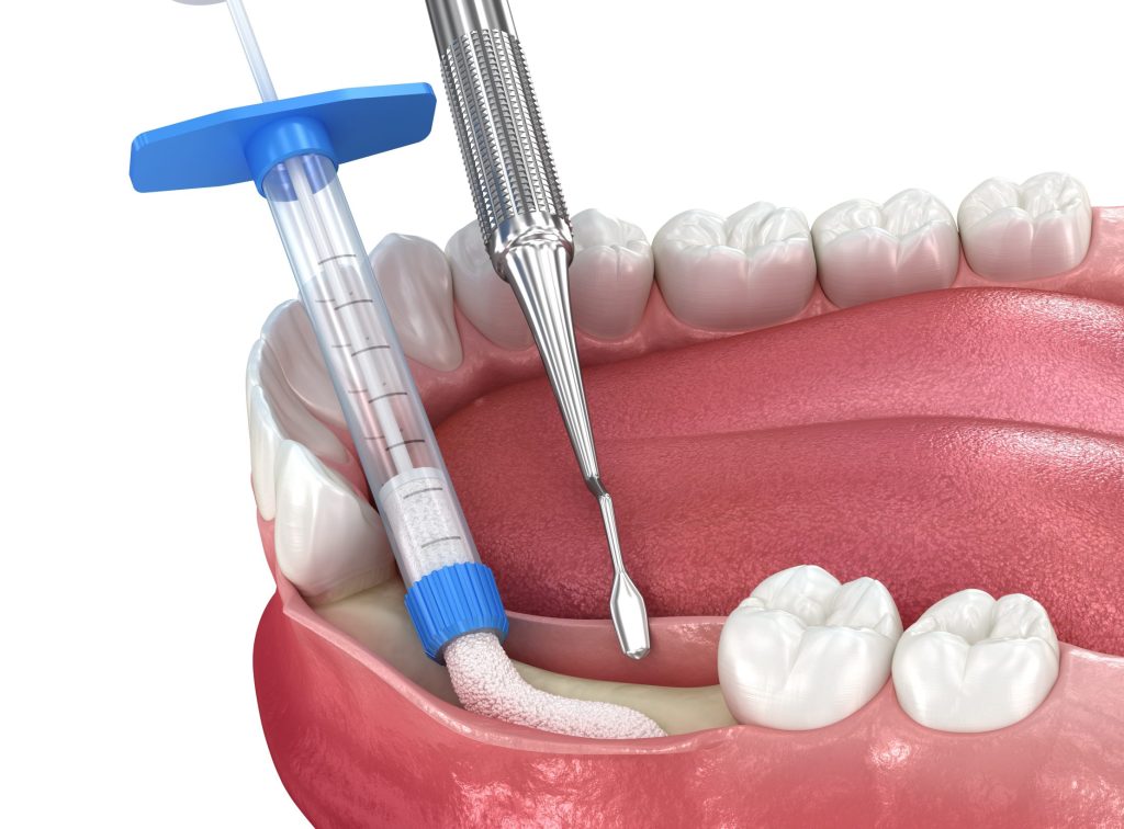 Enhancing Healing with Grafts