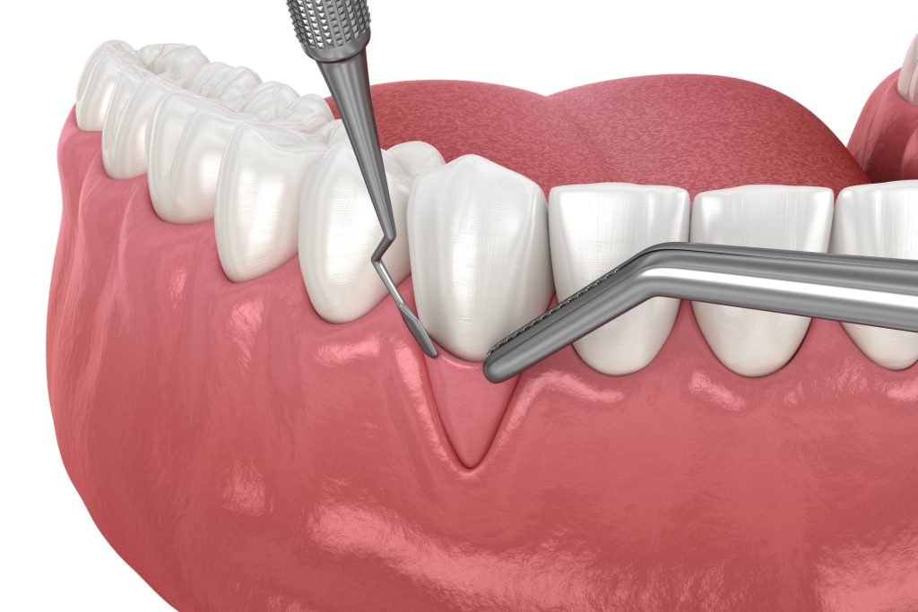 Pedicle Graft