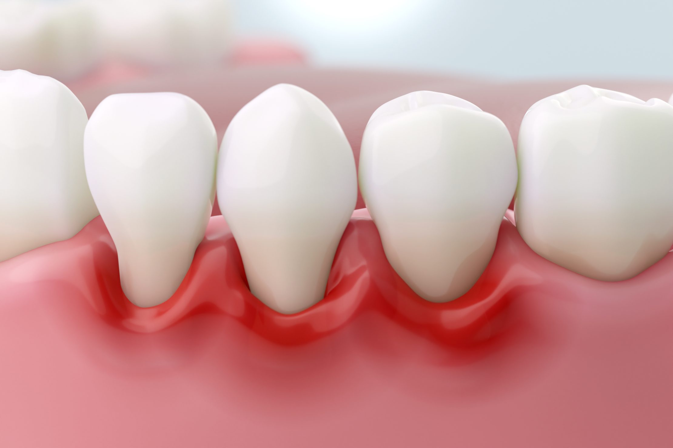 Improved Gum Health for Long-Term Benefits