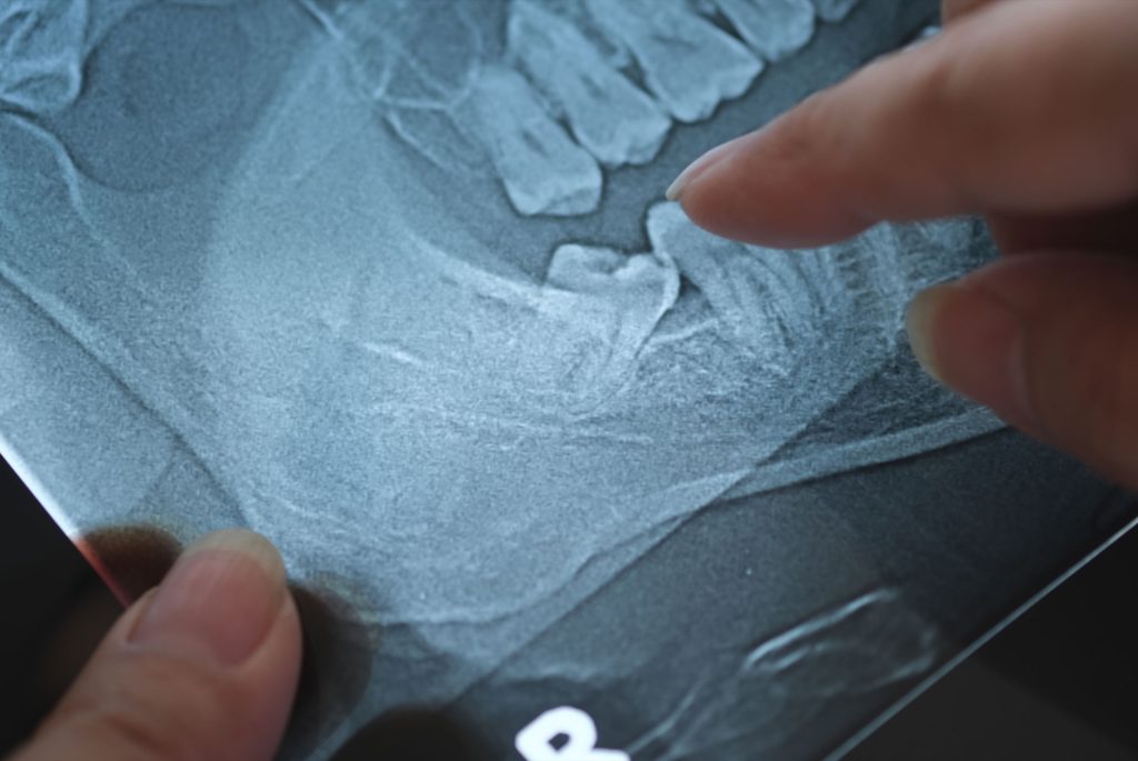 Surgical Extraction
