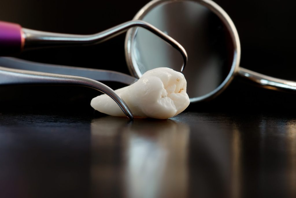 Tooth Extraction