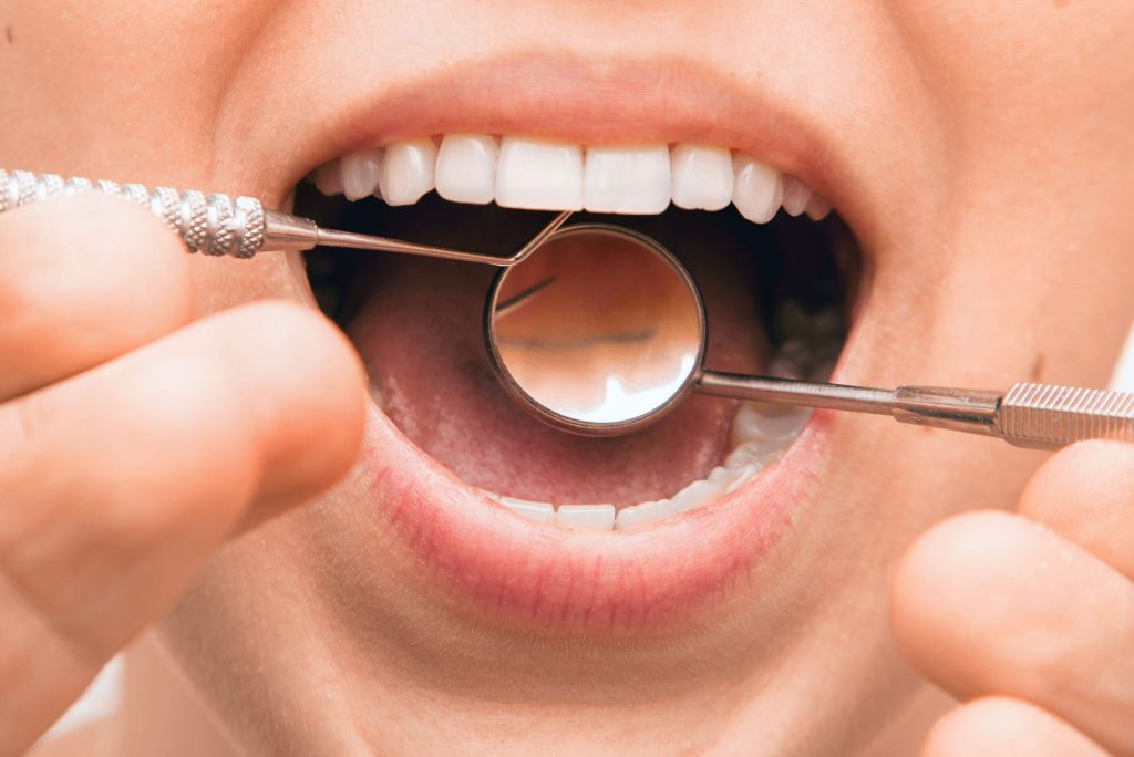 Gingival Graft